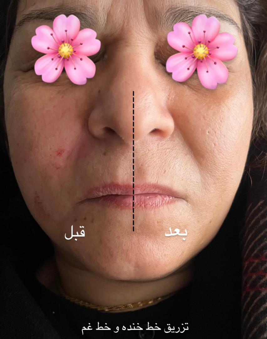 آموزش فیلر و بوتاکس آکادمی دکتر سهرابی در نوبهار کرمانشاه